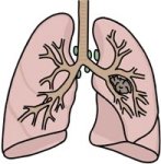 lungcancer